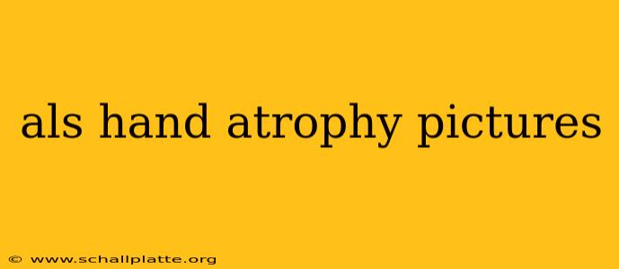 als hand atrophy pictures